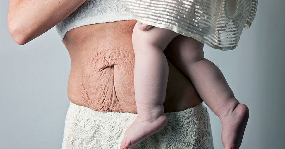 Nhận diện dấu hiệu mẹ bị xổ bụng sau sinh và cách khắc phục