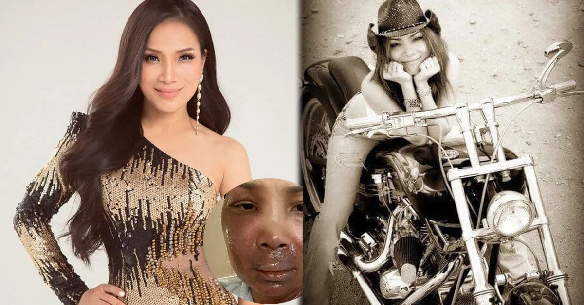 Sau khi công khai vết bỏng ở mặt, Hồng Ngọc lạc quan chia sẻ: Vết thương rồi cũng sẽ lành