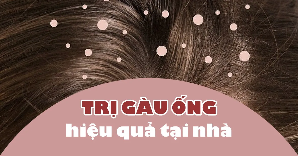 3 cách trị gàu ống đơn giản, hiệu quả, dứt điểm tại nhà