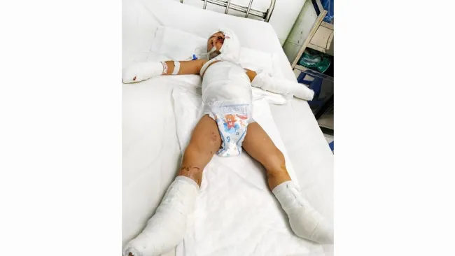 Cảnh báo tai nạn phỏng ở trẻ em