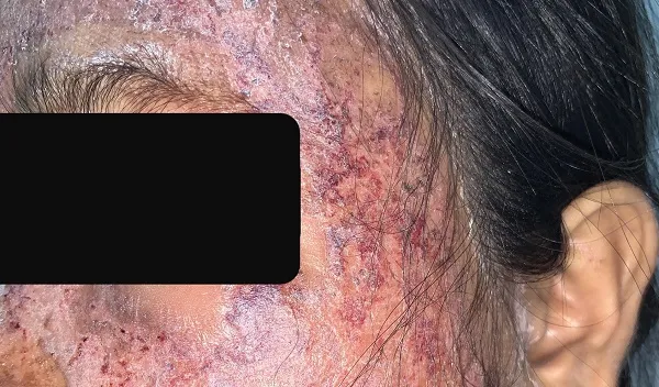 Tai biến nặng vì tự lột làm trắng da mặt