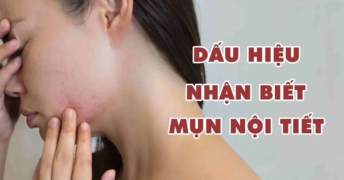 6 dấu hiệu cho thấy bạn đang phải đối mặt với mụn nội tiết