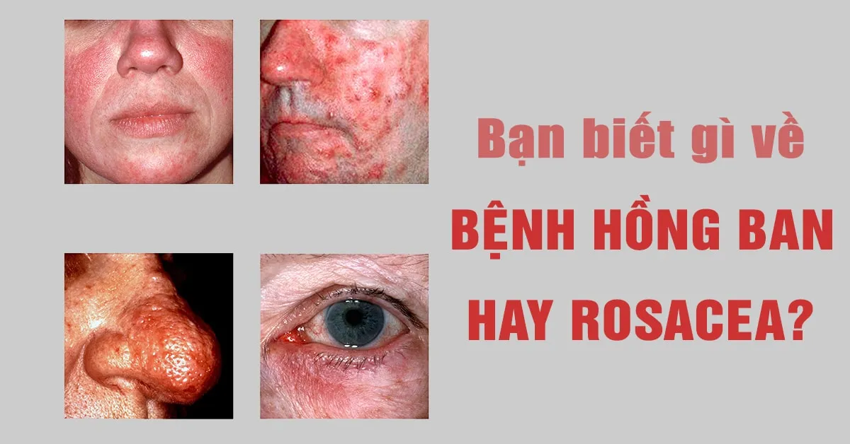 Bạn biết gì về rosacea – bệnh da liễu phổ biến thường bị nhầm lẫn với mụn trứng cá hay da nhạy cảm?
