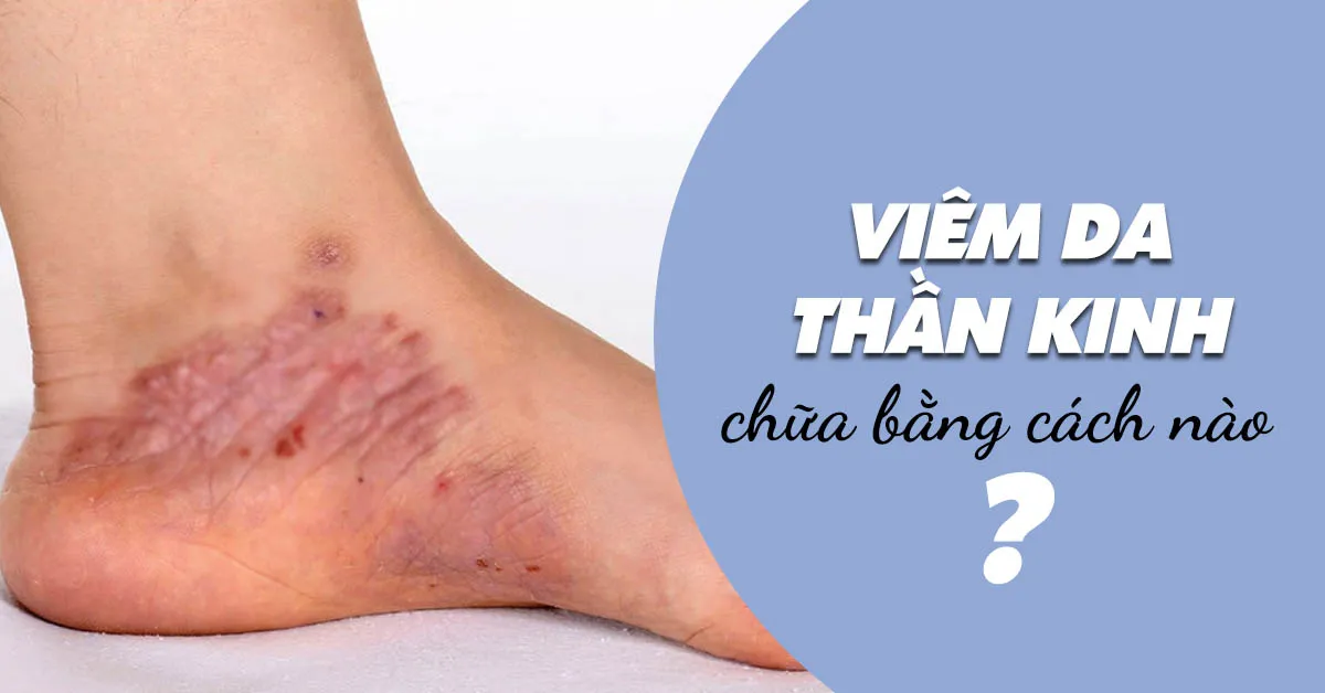 Viêm da thần kinh và những điều cần biết