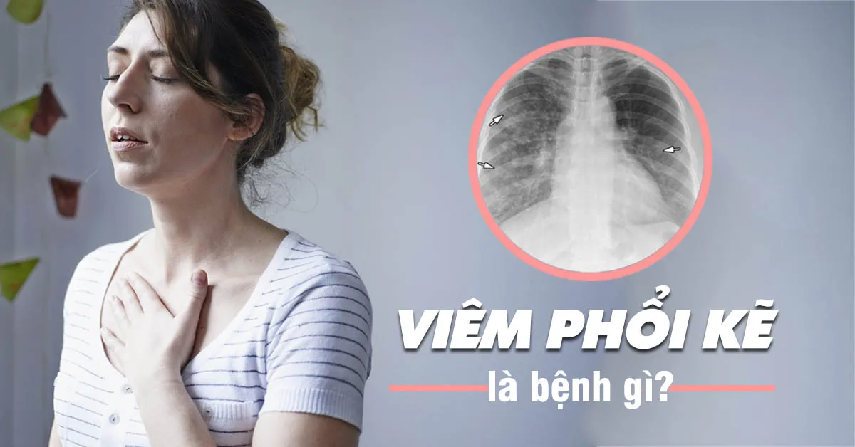 Những điều cần biết về viêm phổi kẽ