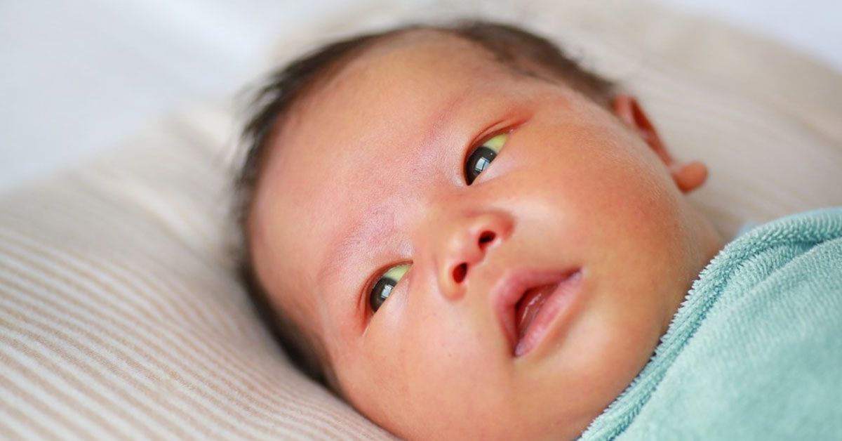 Trẻ sơ sinh bị vàng mắt: Nguyên nhân và cách điều trị