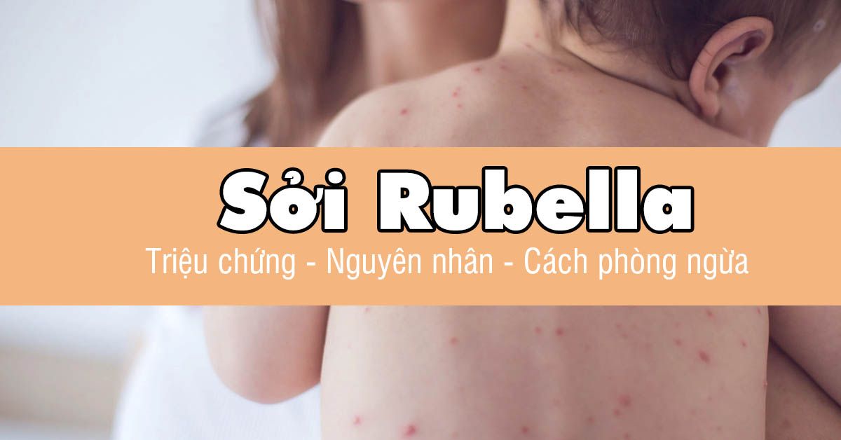 Sởi Rubella và những kiến thức cần biết