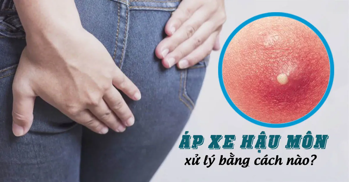 Áp xe hậu môn và những điều cần biết