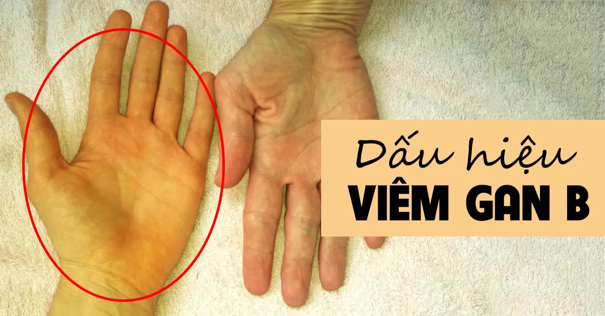 Dấu hiệu của viêm gan B không thể bỏ qua