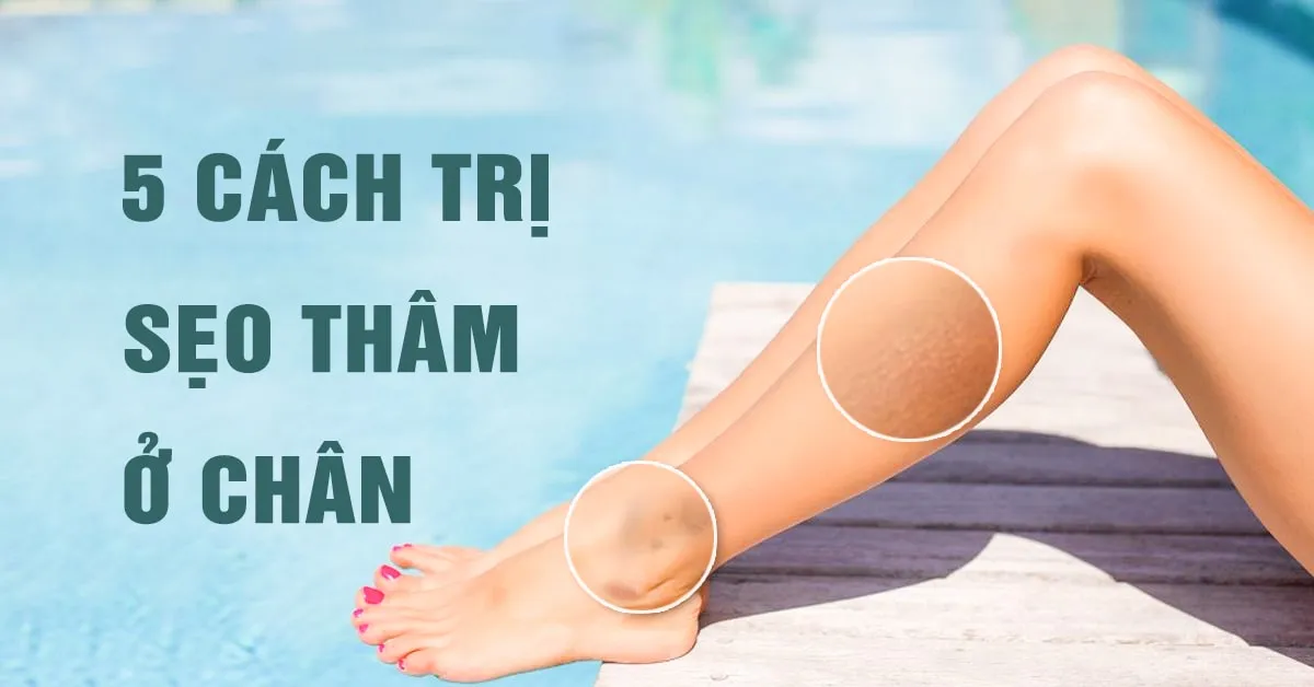 5 cách trị sẹo thâm ở chân đơn giản mà hiệu quả