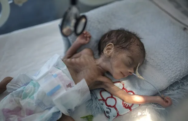 UNICEF: Hàng triệu trẻ em Yemen có thể chết đói trong giai đoạn đại dịch COVID-19