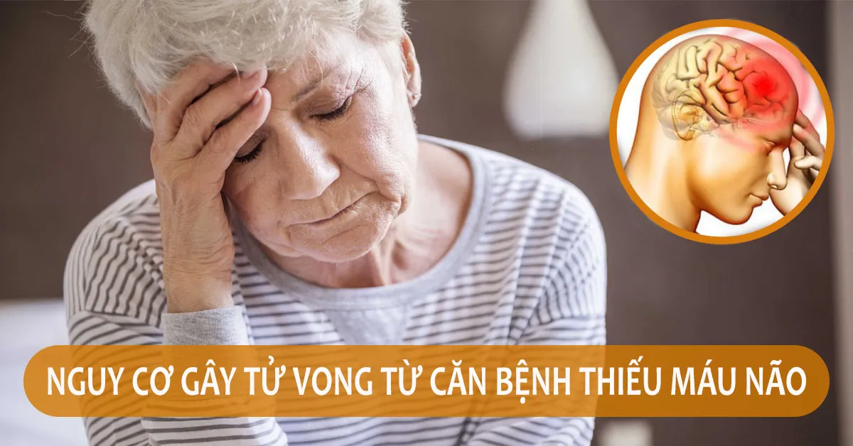 Thiếu máu não: Căn bệnh nguy hiểm nếu không phát hiện và điều trị kịp thời