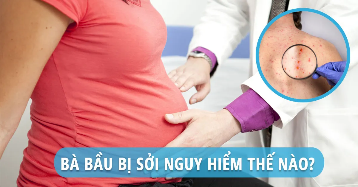 Bà bầu bị sởi và những biến chứng nguy hiểm phải đối mặt trong thai kỳ