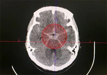 Kịp thời cứu bệnh nhân trẻ bị xuất huyết do vỡ túi phình động mạch não