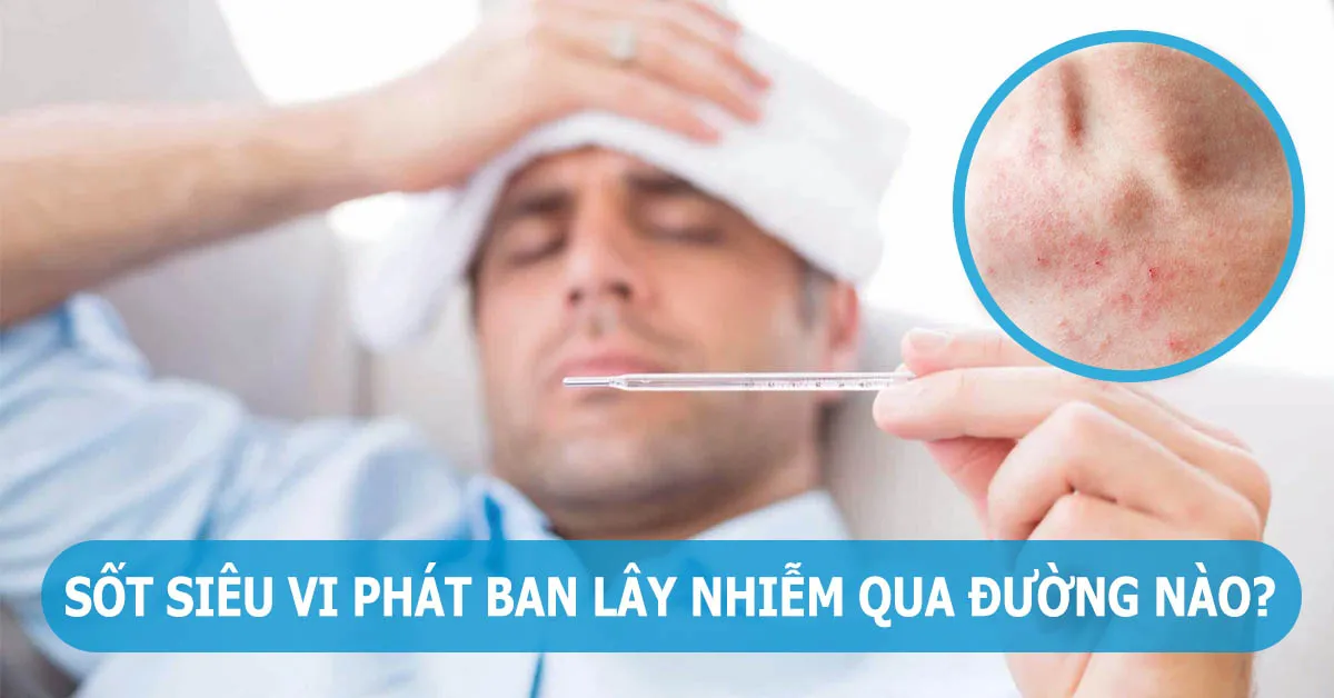 Sốt siêu vi phát ban: Dấu hiệu, nguyên nhân, đối tượng dễ mắc phải và cách phòng ngừa