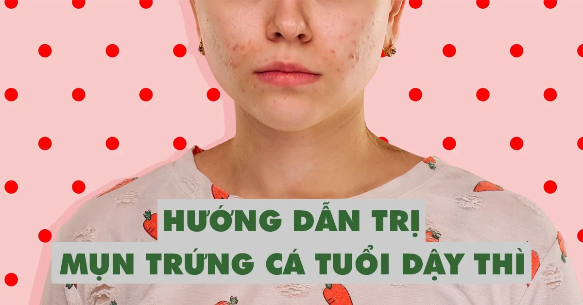 Cách trị mụn trứng cá tuổi dậy thì tại nhà an toàn và hiệu quả