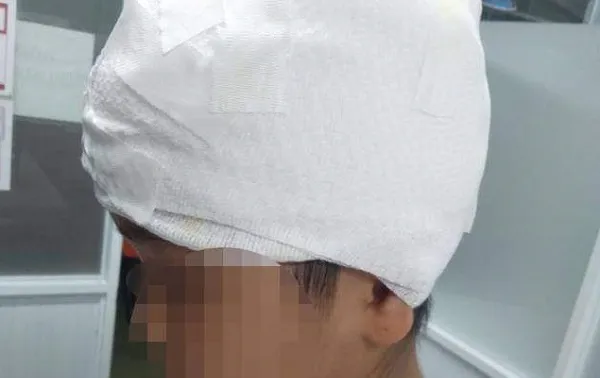 Bé gái bị máy cưa nước đá lột gần nửa diện tích da đầu được vi phẫu vá thành công