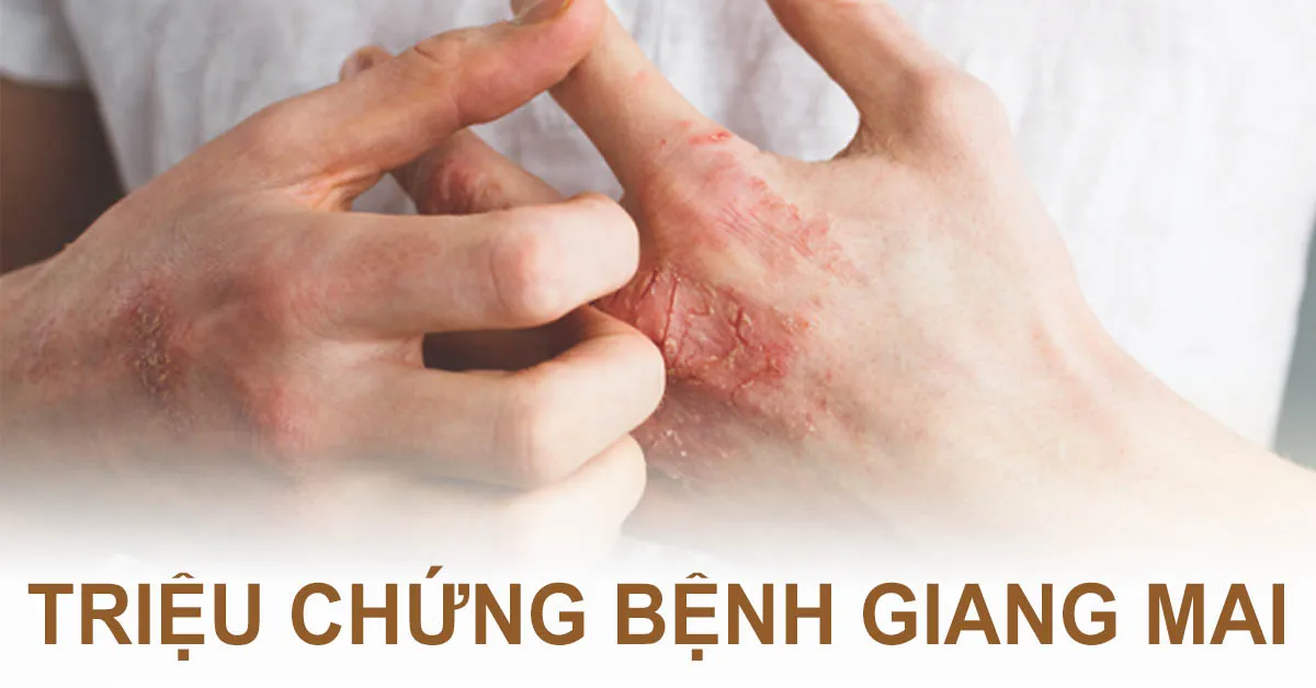 Dấu hiệu bệnh giang mai biểu hiện qua mấy giai đoạn?