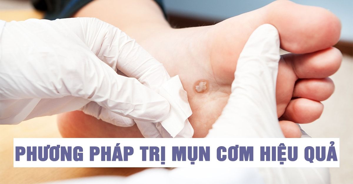Trị mụn cơm đúng cách để tránh lây lan