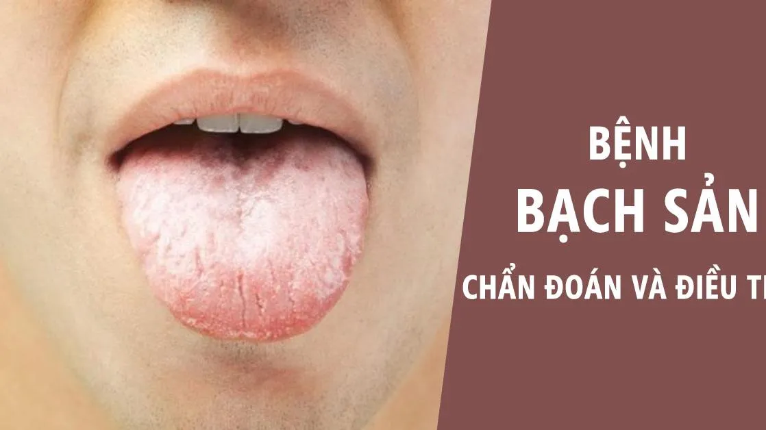 Bệnh bạch sản là gì? Nguyên nhân và cách điều trị