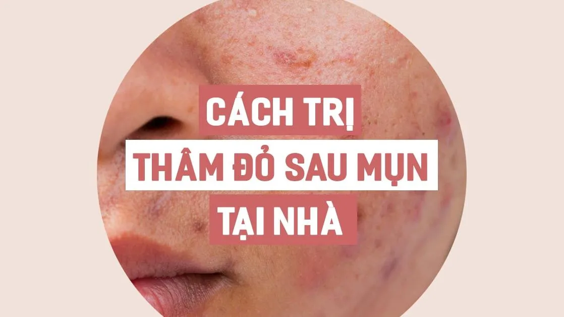 Cách trị sẹo thâm đỏ sau mụn nhanh và hiệu quả tại nhà