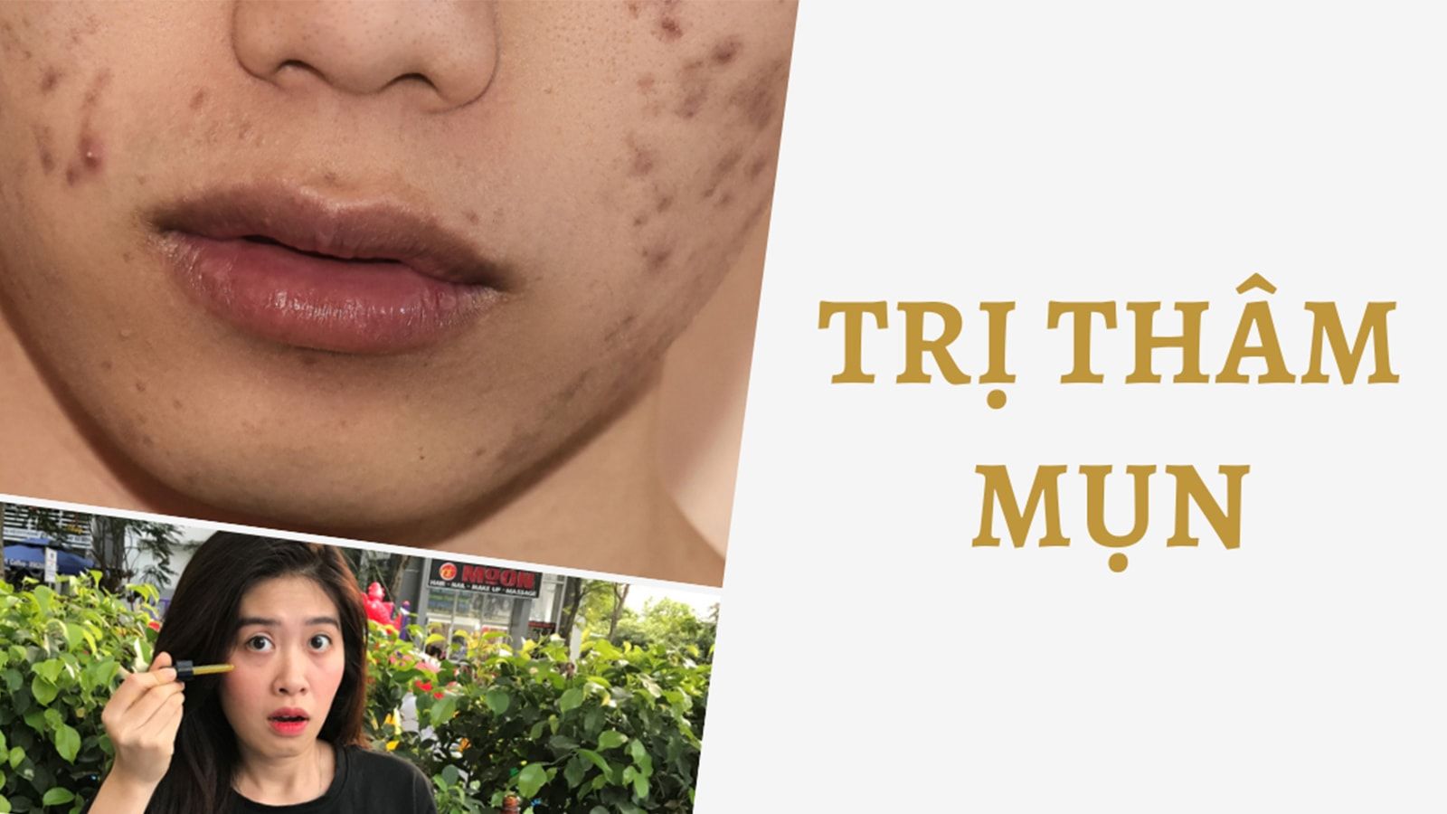5 cách trị mụn thâm nhanh chóng, hiệu quả và tự nhiên