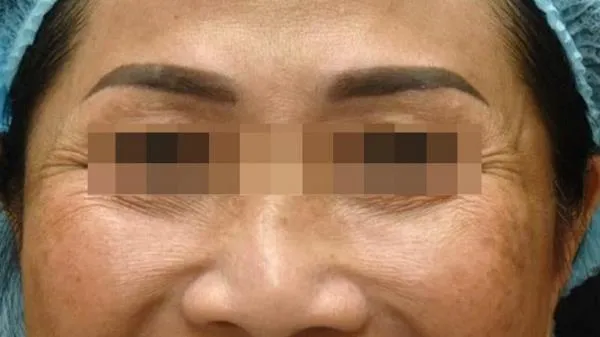 An toàn khi sử dụng botulinum trong thẩm mỹ theo liều chỉ định