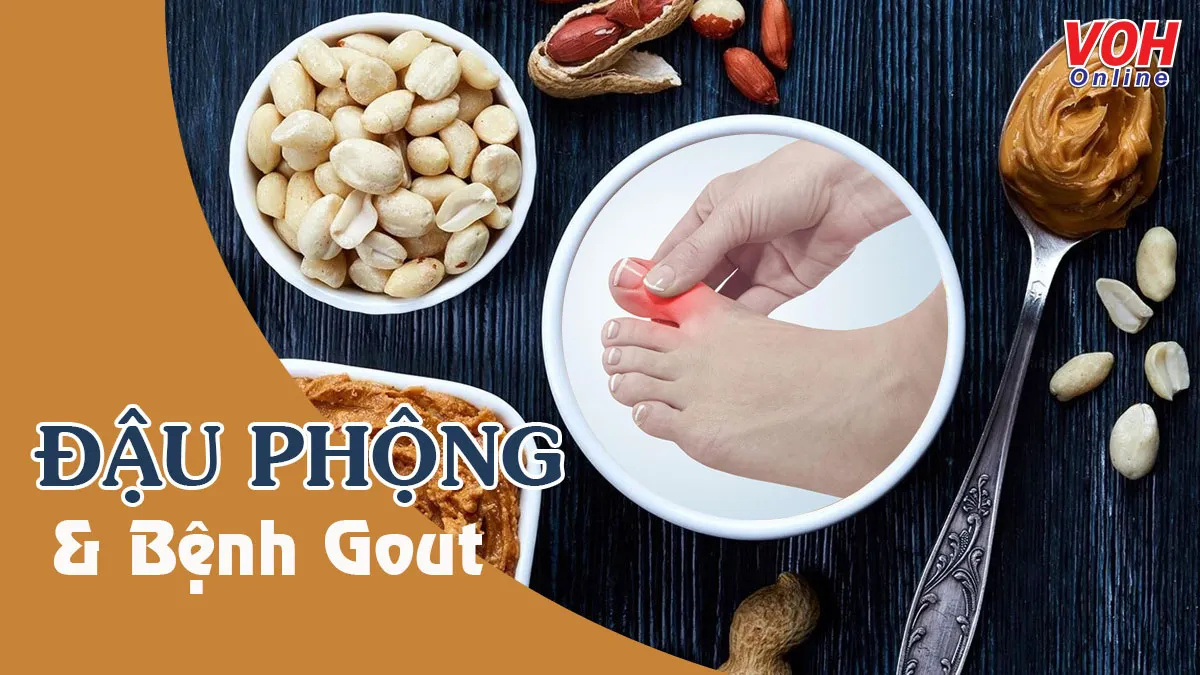 Bệnh gút ăn đậu phộng được không?