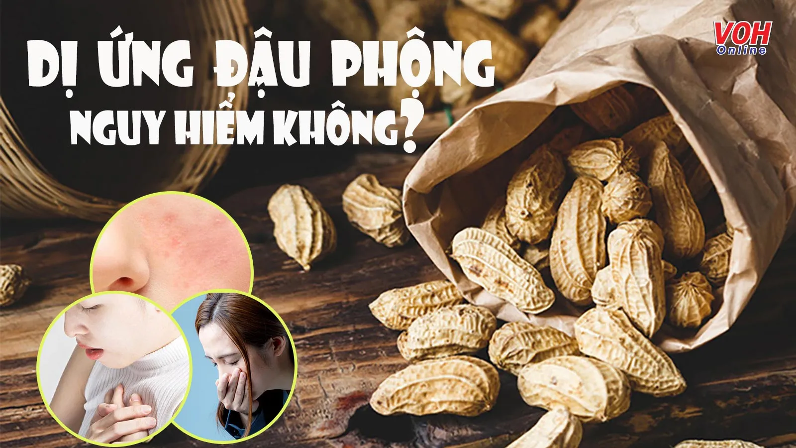 Dị ứng đậu phộng: Triệu chứng, nguyên nhân và phòng ngừa