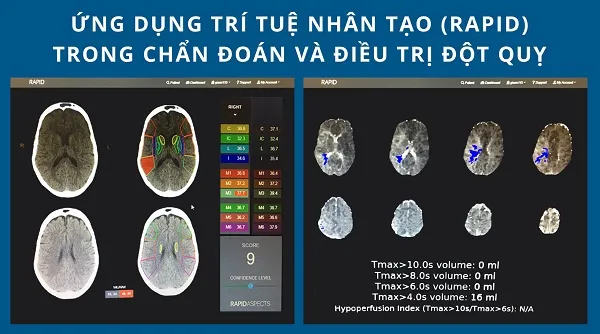 Tầm soát nguy cơ đột quỵ, xơ vữa động mạch ở đâu?