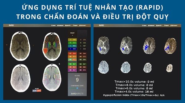 Tầm soát nguy cơ đột quỵ, xơ vữa động mạch ở đâu?