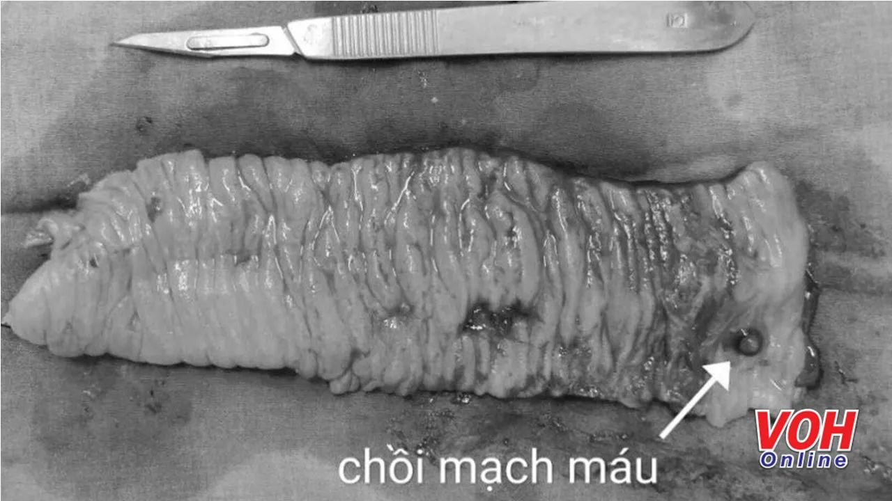 Chảy máu ruột non hiếm gặp, phát hiện nhờ kỹ thuật nội soi bằng viên nang