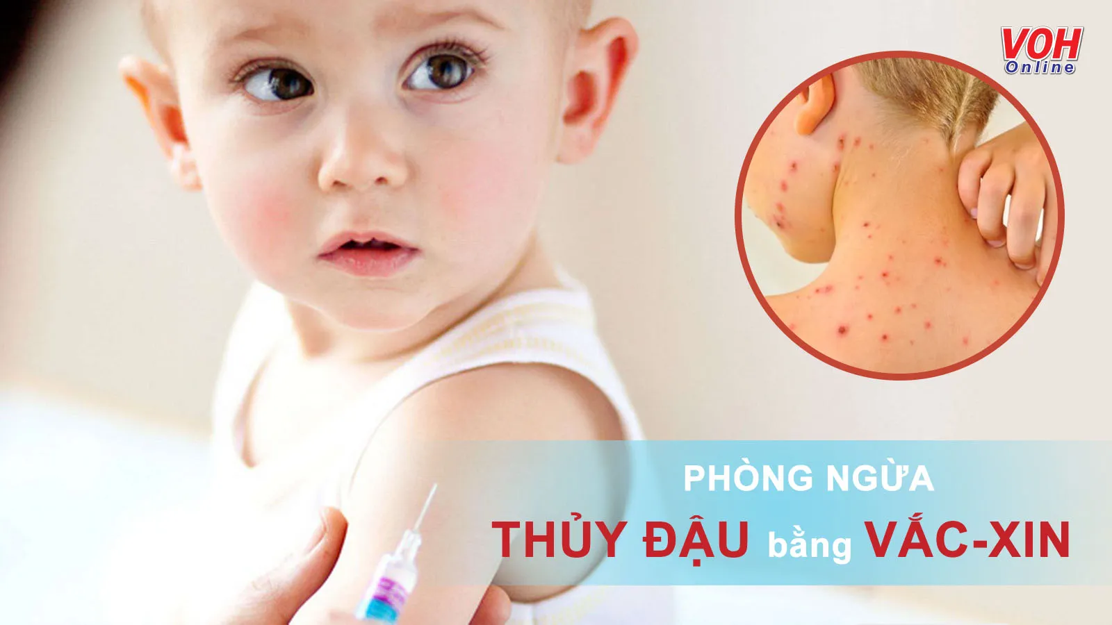 Vacxin thủy đậu là gì, gồm những loại nào?