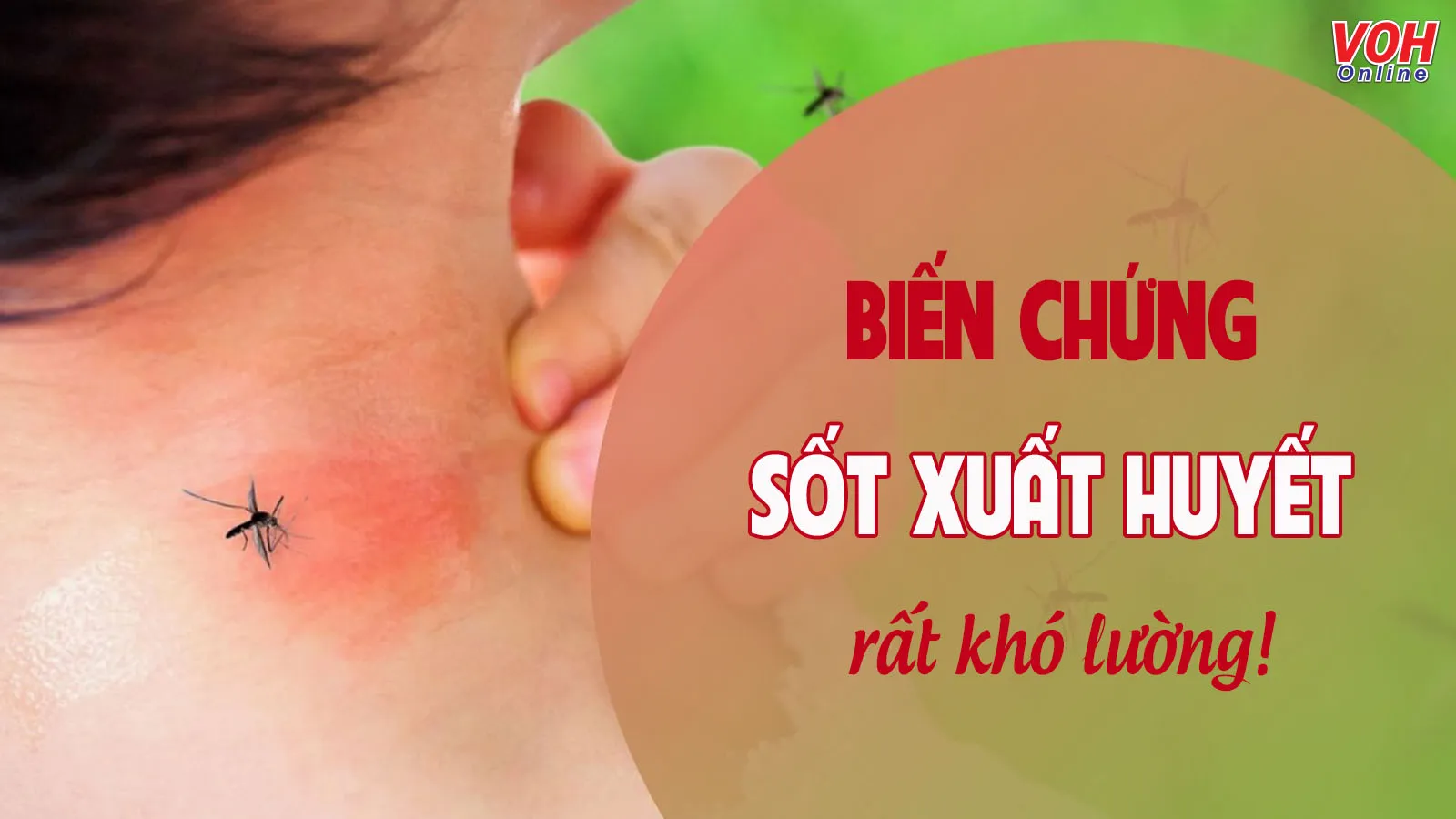 7 biến chứng sốt xuất huyết cần chủ động đề phòng