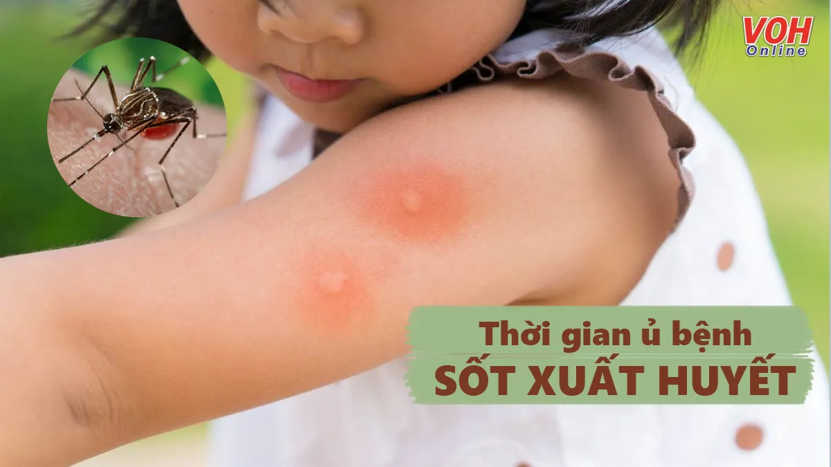 Thời gian ủ bệnh sốt xuất huyết diễn ra trong bao lâu?