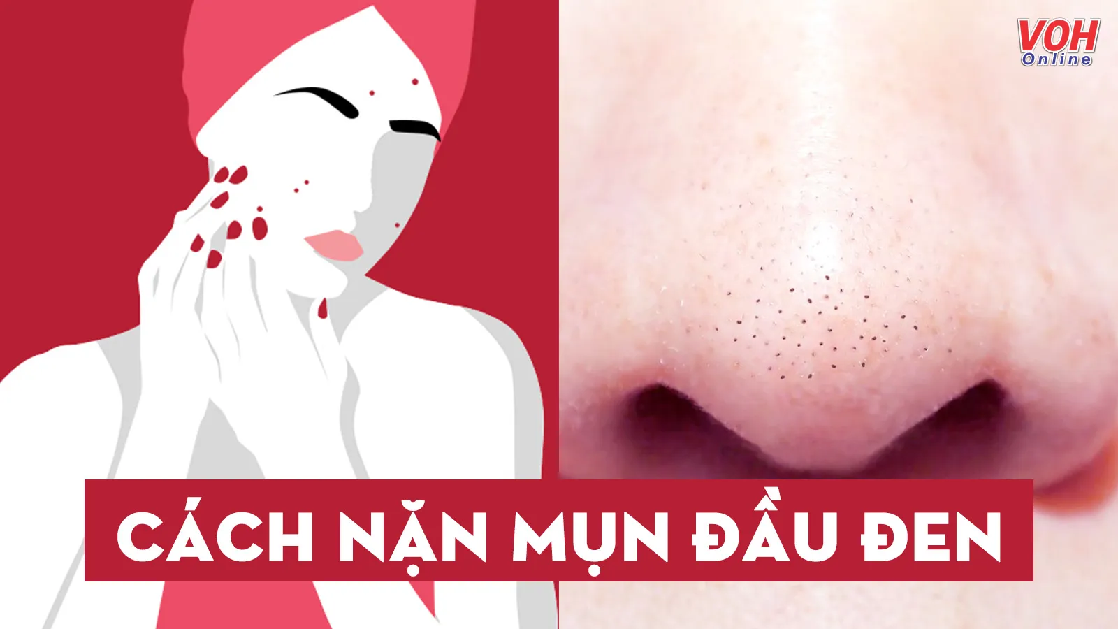 Cách nặn mụn đầu đen tại nhà nhanh lành và không để lại thâm sẹo