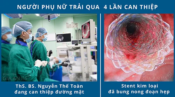 Đặt stent kéo dài thời gian sống bệnh nhân ung thư đường mật ngoài gan