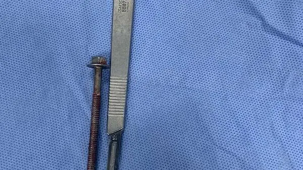 Bệnh viện Bình Dân phẫu thuật bóc tách lấy một vít dài 6cm từ niệu đạo