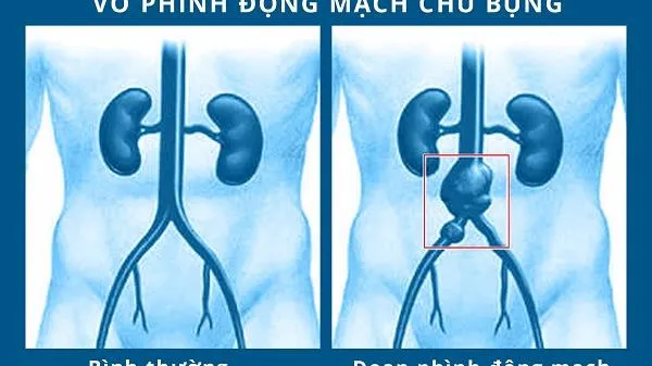 Cứu cụ ông 82 tuổi bị vỡ túi phình động mạch chậu chung