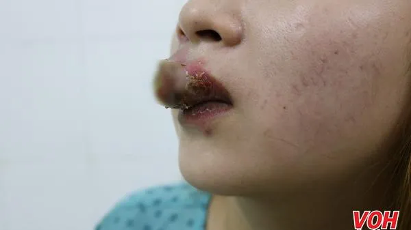 Bác sĩ cảnh báo về nhiều trường hợp tai biến do xăm môi