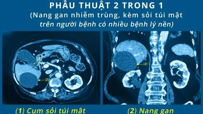 Thực hiện cùng lúc hai ca phẫu thuật cho cụ bà 85 tuổi
