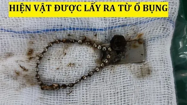 Xử trí lấy dị vật cho bé trai 6 tuổi nhiễm trùng ổ bụng nặng