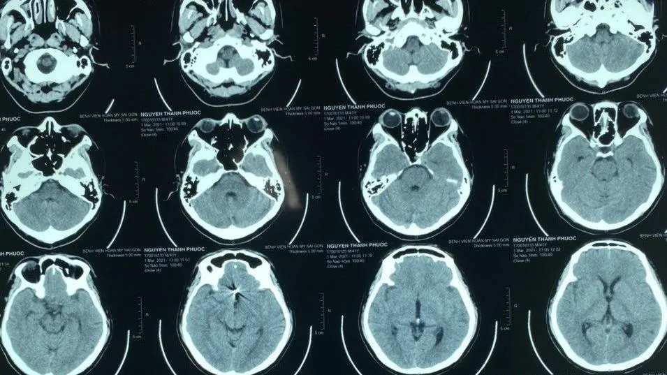 Hãy cẩn trọng với những cơn đau buốt đầu do vỡ túi phình mạch máu não