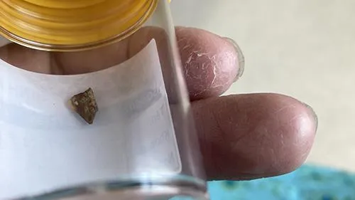 Đi tầm soát sức khỏe tình cờ lại phát diện dị vật trong ruột