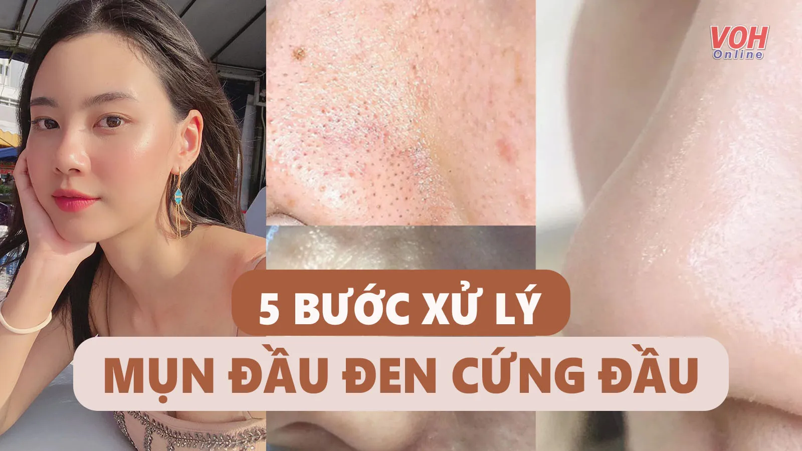 5 bước loại bỏ mụn đầu đen nhẹ nhàng giúp lỗ chân lông thoáng mịn