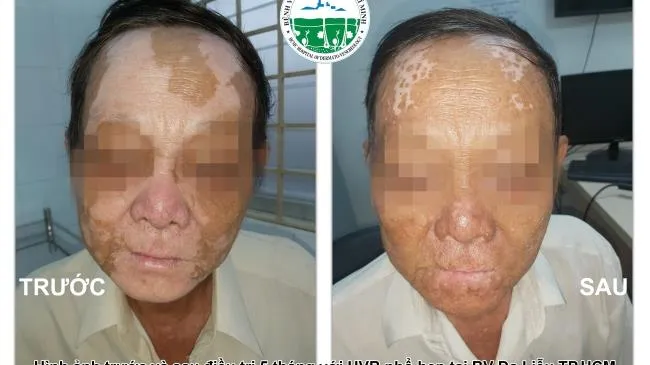 Những điều cần biết về bệnh bạch biến