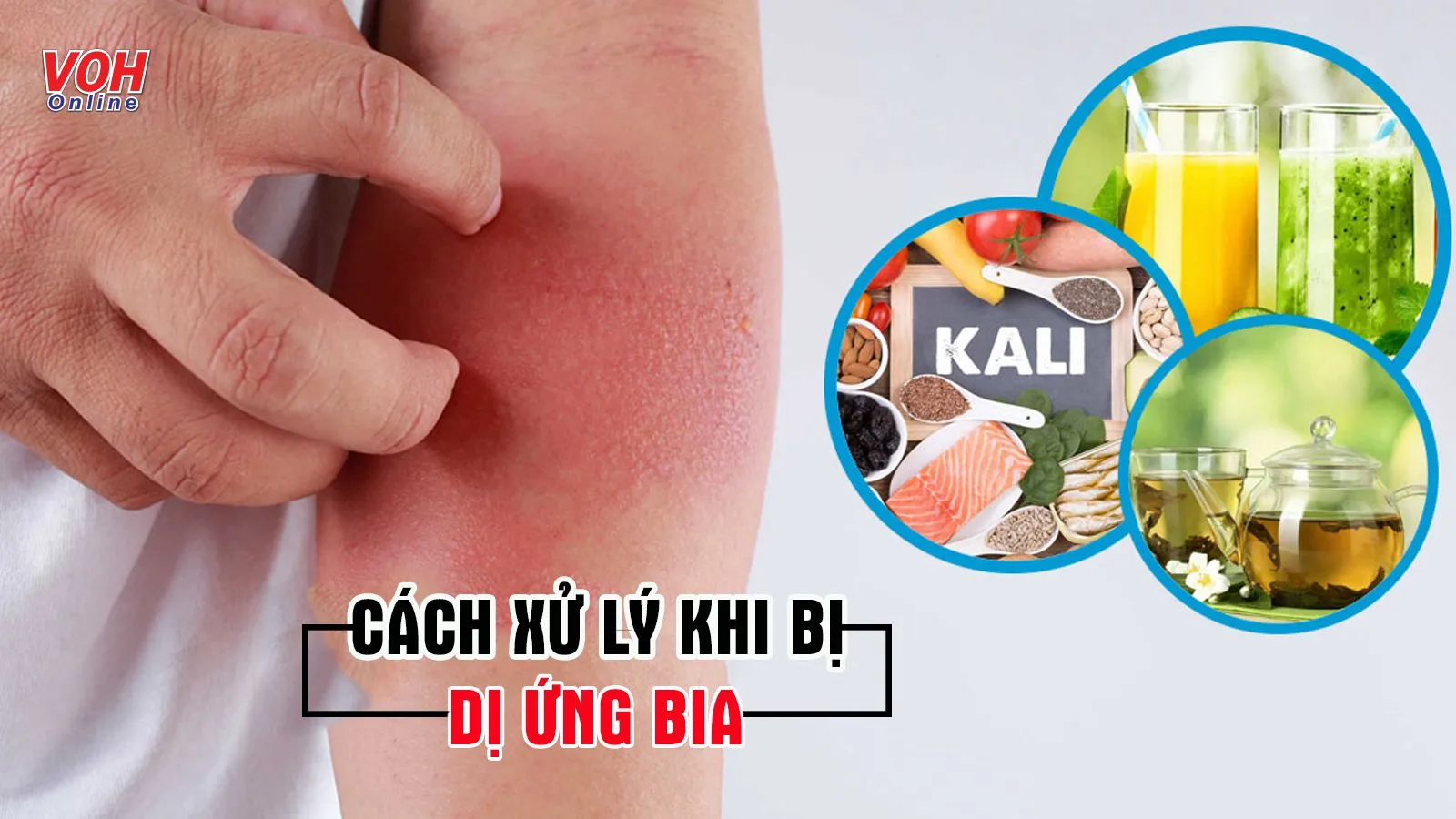 Dị ứng bia – các dấu hiệu thường gặp và phương pháp điều trị