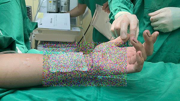 Nối liền kịp thời cổ bàn tay bị đứt lìa