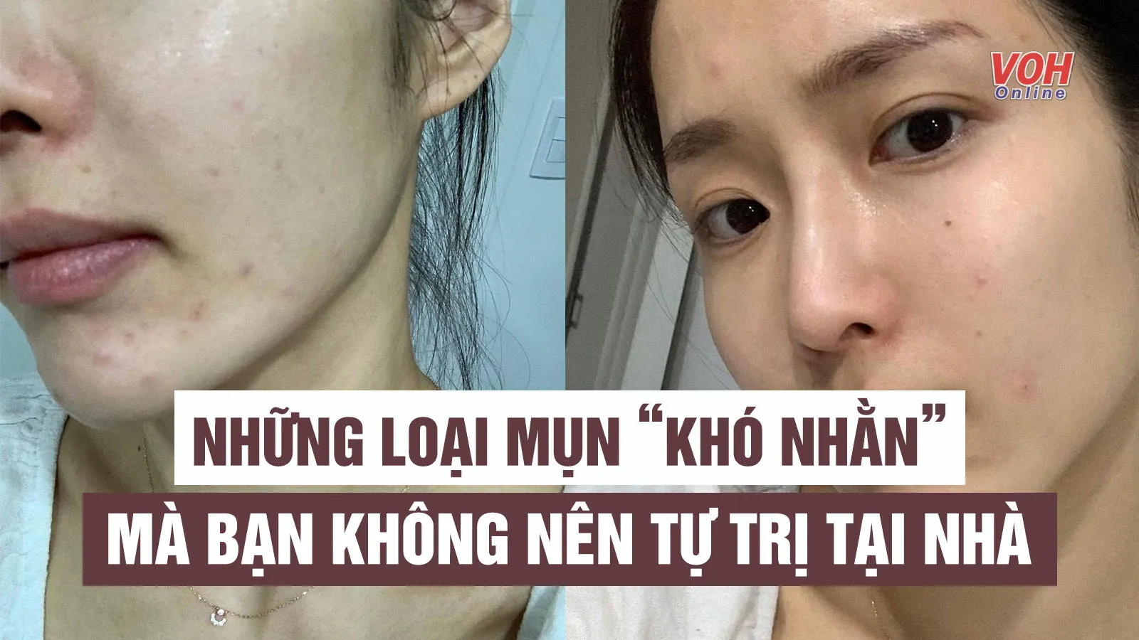 4  loại mụn nên được điều trị bởi bác sĩ có chuyên môn