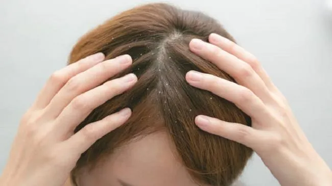 Tạm biệt nỗi lo GÀU mùa hanh khô, da đầu khỏe nhờ giải pháp chuyên nghiệp